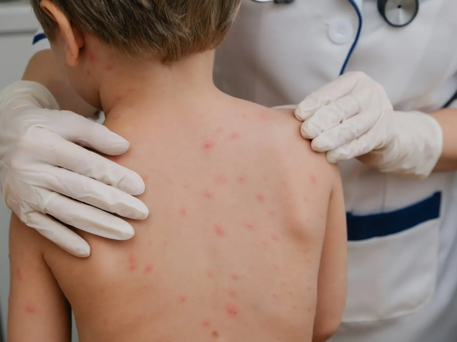 Chickenpox Vaccination