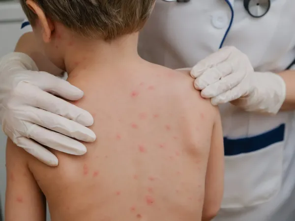 Chickenpox Vaccination