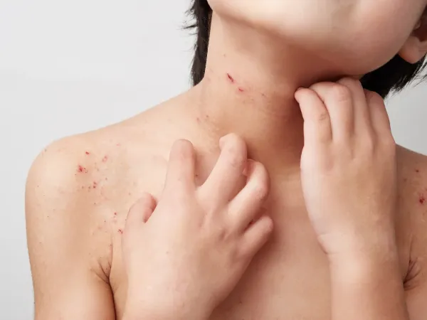 Impetigo Treatment