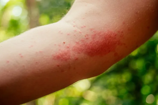Infected Insect Bites